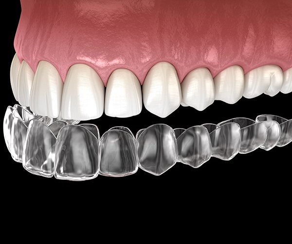 Illustration of clear aligner being placed on upper teeth