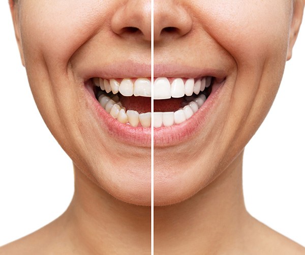 Nose-to-chin before/after shot comparing a smile pre and post veneers